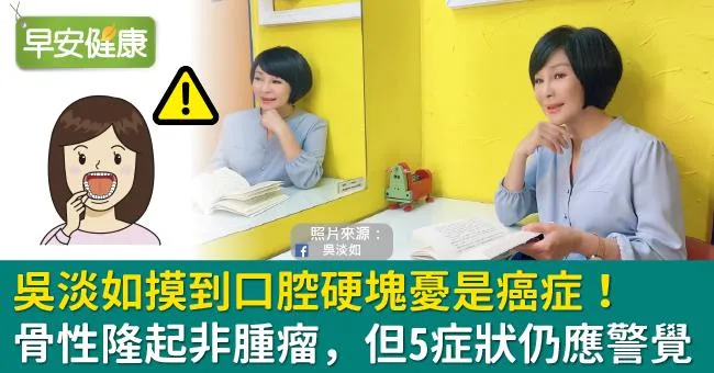 吳淡如摸到口腔硬塊憂是癌症！骨性隆起非腫瘤，但5症狀仍應警覺