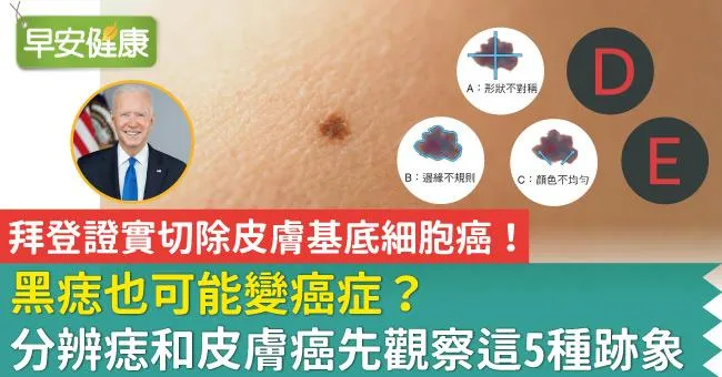 拜登證實切除皮膚基底細胞癌！黑痣也可能變癌症？分辨痣和皮膚癌先觀察這5種跡象