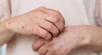M痘變種病毒來襲，單月激增18例創新高！一族群「快打兩劑疫苗」