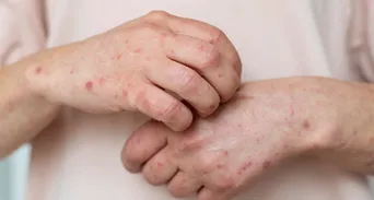 濕疹、乾癬反覆發作？9種刺激性食物快戒，醫5招抗敏護膚