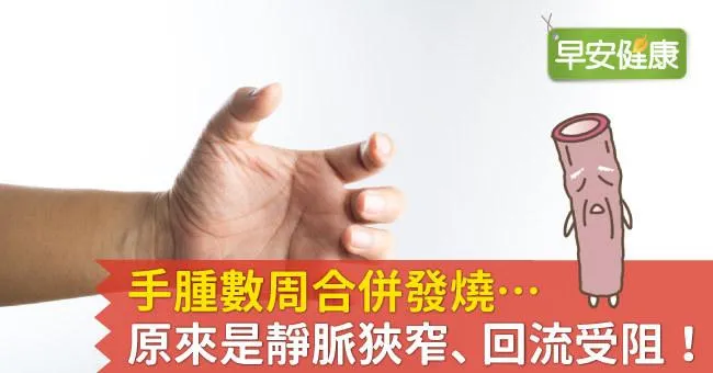 手腫數周合併發燒…原來是靜脈狹窄、回流受阻！
