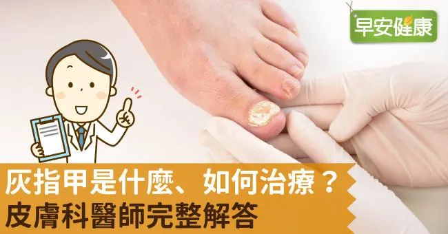 灰指甲是什麼、如何治療？皮膚科醫師完整解答