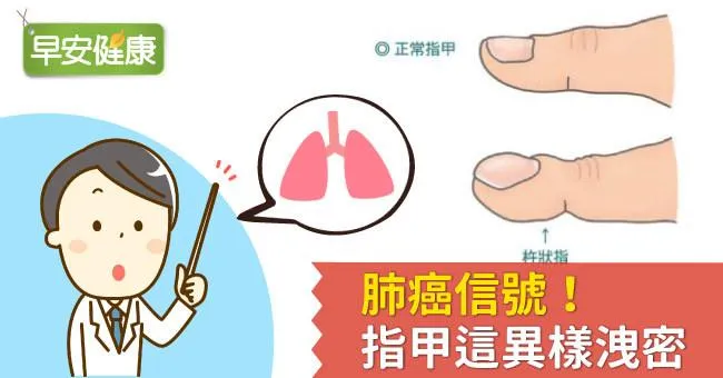 肺癌信號！指甲這異樣洩密