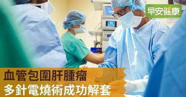 血管包圍肝腫瘤 多針電燒術成功解套