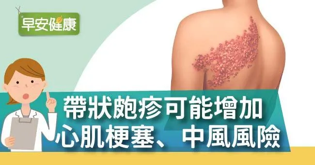 帶狀皰疹可能增加心肌梗塞、中風風險