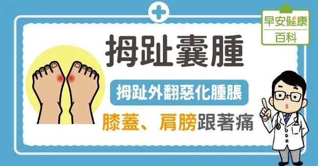 拇趾囊腫：拇指外翻惡化腫脹，膝蓋、肩膀跟著痛