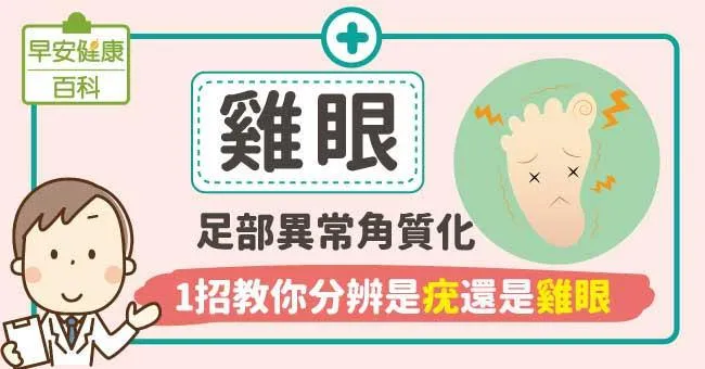 雞眼治療貼貼布、藥膏有效嗎？與繭/足底疣怎麼分辨？預防腳底長雞眼，1招真正根治讓雞眼自己好！