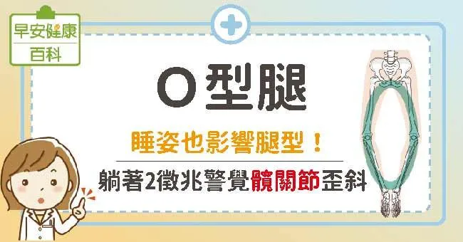 O型腿：睡姿也影響腿型！躺著2徵兆警覺髖關節歪斜