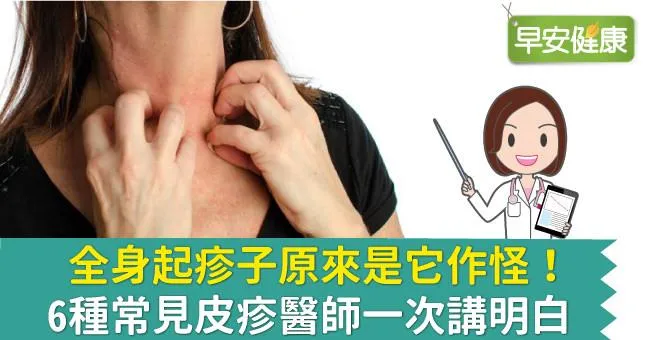 全身起疹子原來是它作怪！6種常見皮疹醫師一次講明白
