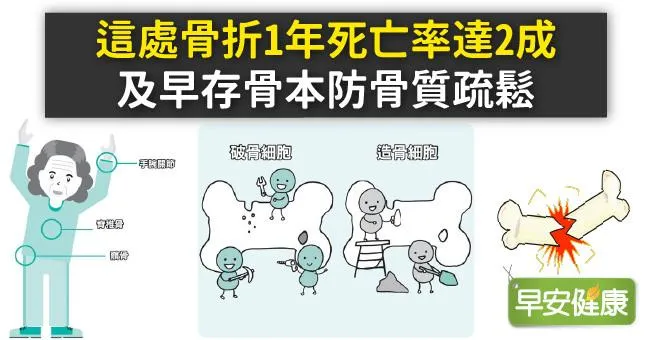 這處骨折1年死亡率達2成，及早存骨本防骨質疏鬆