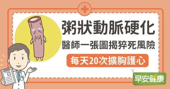 粥狀動脈硬化：醫師一張圖揭猝死風險，每天20次擴胸護心