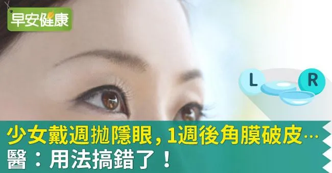 少女戴週拋隱眼，1週後角膜破皮…醫：搞錯了！