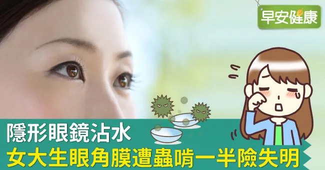 隱形眼鏡沾水，女大生眼角膜遭蟲啃一半險失明