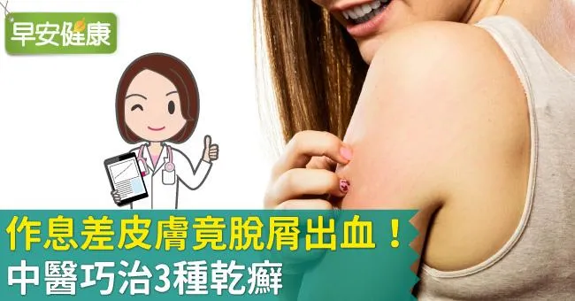 作息差皮膚竟脫屑出血！中醫巧治3種乾癬