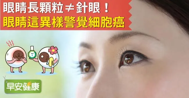 眼睛長顆粒≠針眼！眼睛這異樣警覺細胞癌