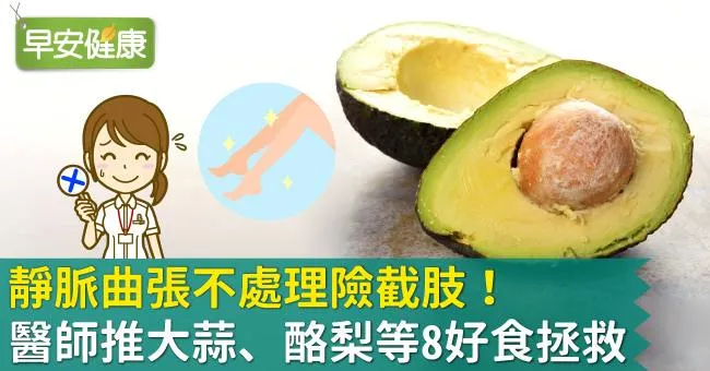 靜脈曲張不處理險截肢！醫師推大蒜、酪梨等8好食拯救