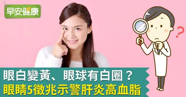 眼白變黃、眼球有白圈？眼睛5徵兆示警肝炎高血脂