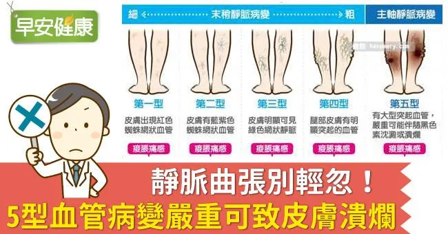 靜脈曲張別輕忽！5型血管病變嚴重可致皮膚潰爛