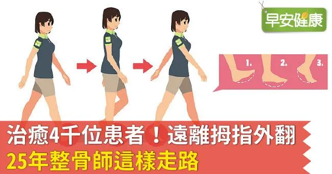治癒4千位患者！遠離拇指外翻，25年整骨師這樣走路