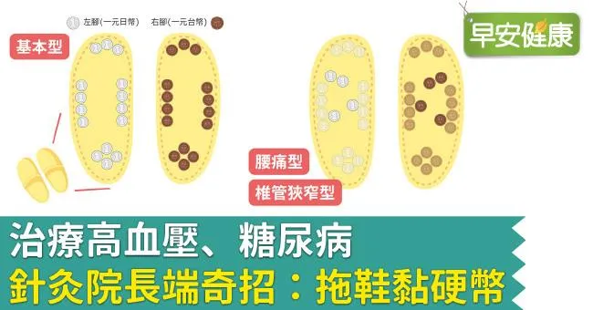 治療高血壓、糖尿病，針灸院長端奇招：拖鞋黏硬幣