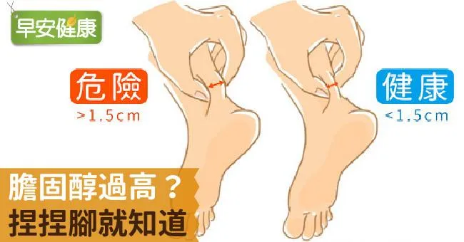 膽固醇過高？捏捏腳就知道