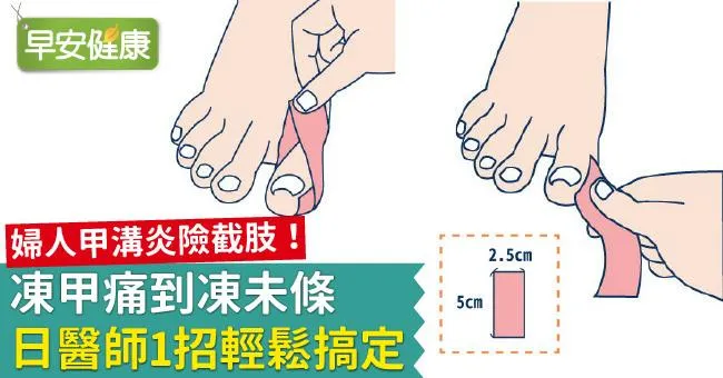 婦人甲溝炎險截肢！凍甲痛到凍未條日醫師1招輕鬆搞定