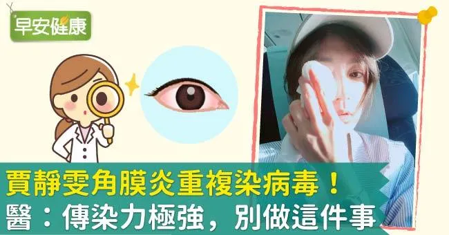 賈靜雯角膜炎重複染病毒！醫：傳染力極強，別做這件事