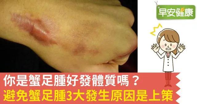 你是蟹足腫好發體質嗎？避免蟹足腫3大發生原因是上策
