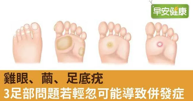 雞眼、繭、足底疣，3足部問題若輕忽可能導致併發症