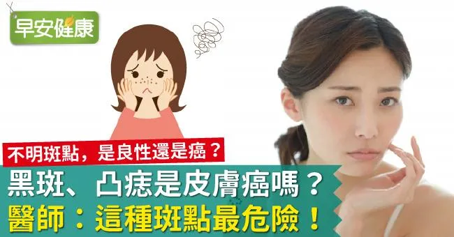 黑斑、臉上皮膚長黑點，是皮膚癌嗎？皮膚科醫師：這3種黑斑狀態最危險！