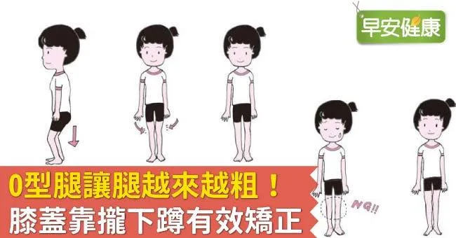O型腿讓腿越來越粗！膝蓋靠攏下蹲有效矯正