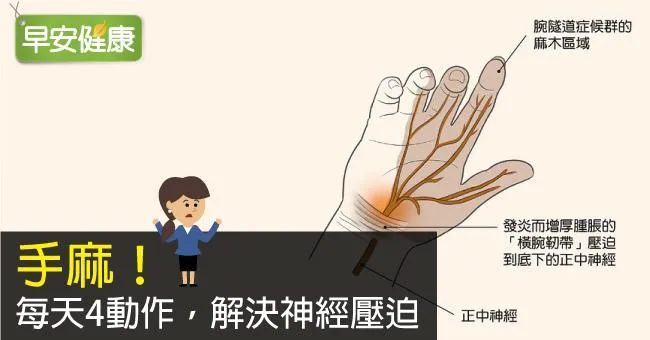 手麻很久、大拇指麻，是腕隧道症候群症狀嗎？手麻怎麼辦？醫師教4動作緩解