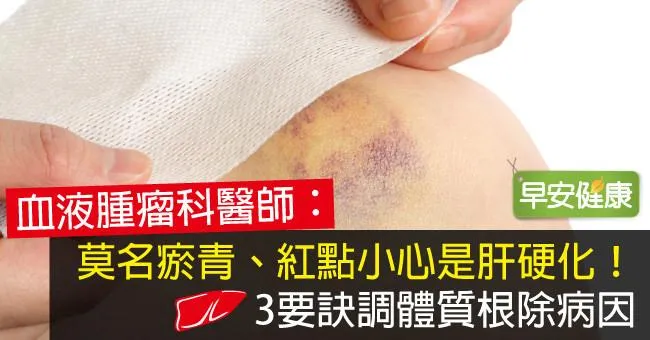 消瘀青正確方法！莫名瘀青要緊嗎？竟要注意肝硬化？