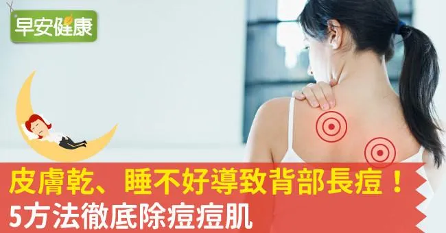 背長痘痘是皮膚乾、睡不好！5招徹底改善背部長痘
