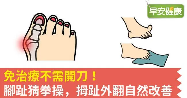 免治療不需開刀！腳趾猜拳操，拇趾外翻自然改善
