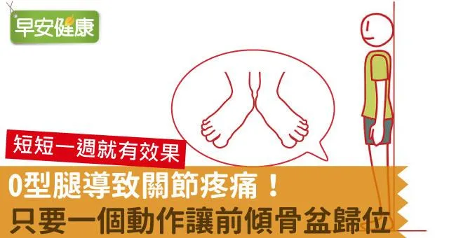 O型腿導致關節疼痛！只要一個動作讓前傾骨盆歸位