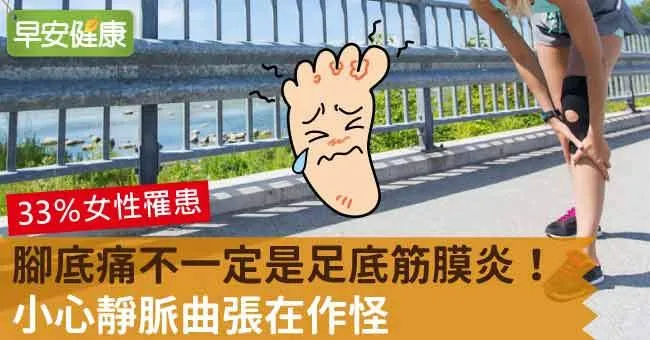 腳底痛不一定是足底筋膜炎！小心靜脈曲張在作怪