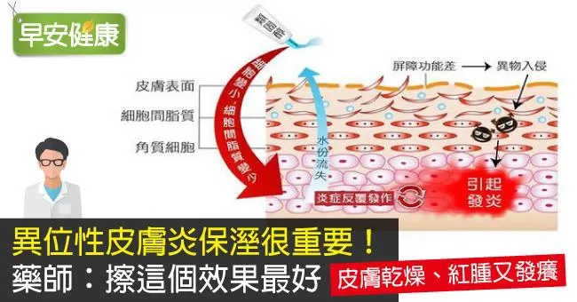 異位性皮膚炎保溼很重要！藥師：擦這個效果最好