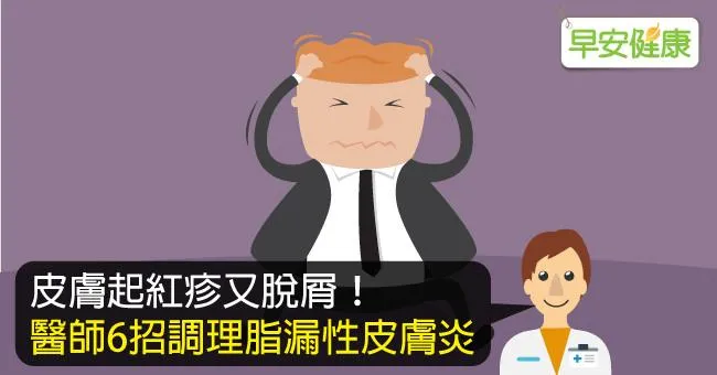 惱人的脂漏性皮膚炎