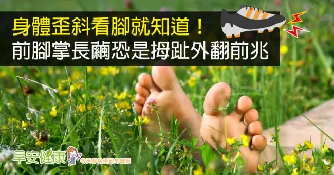 身體歪斜看腳就知道！前腳掌長繭恐是拇趾外翻前兆