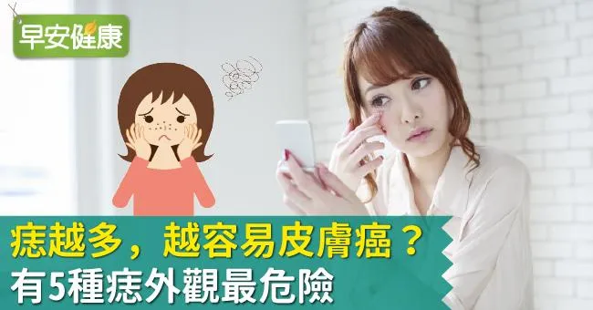 痣越多，越容易皮膚癌？有5種痣外觀最危險