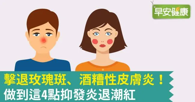 玫瑰斑、酒糟性皮膚炎怎麼辦？預防發炎、潮紅這靠這4點