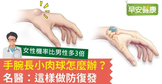 手腕長小肉球怎麼辦？名醫：這樣做防復發