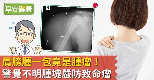 肩膀腫一包竟是腫瘤！警覺不明腫塊嚴防致命瘤