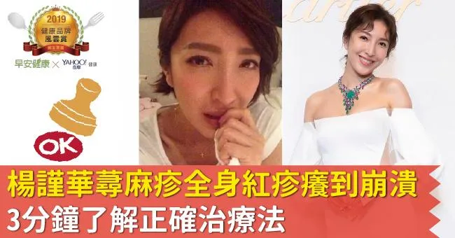 楊謹華蕁麻疹全身紅疹癢到崩潰 3分鐘了解正確治療法