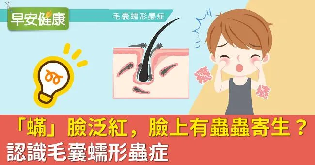「蟎」臉泛紅，臉上有蟲蟲寄生？認識毛囊蠕形蟲症