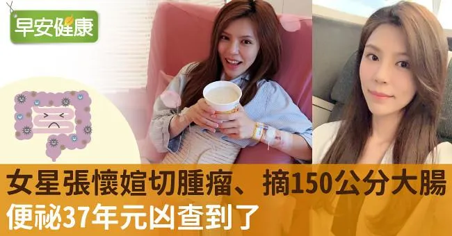 女星張懷媗切腫瘤、摘150公分大腸！便祕37年元凶查到了