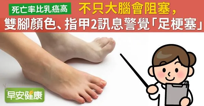 不只大腦會阻塞，雙腳顏色、指甲2訊息警覺「足梗塞」