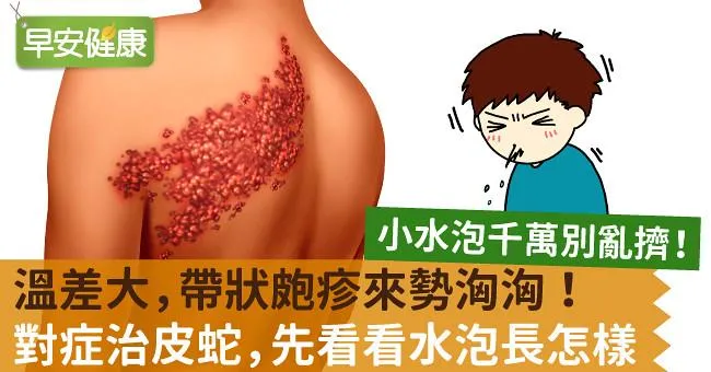 溫差大，帶狀皰疹來勢洶洶！對症治皮蛇，先看看水泡長怎樣