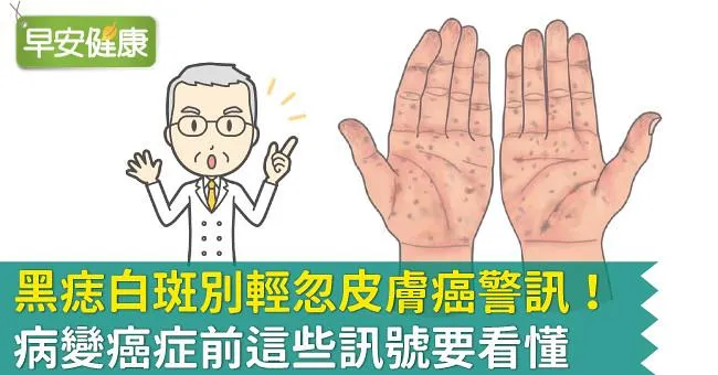 黑痣白斑別輕忽皮膚癌警訊！病變癌症前這些訊號要看懂